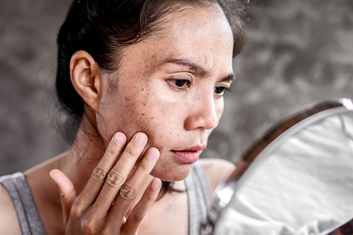 Mujer asiática que tiene problemas de piel comprobar su cara con mancha oscura, pecas de la luz UV photo