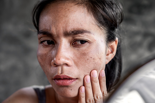 Mujer asiática que tiene problemas de piel comprobar su cara con mancha oscura, pecas de la luz UV photo