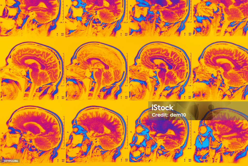 MRI scan of brain MRI Scan Stock Photo