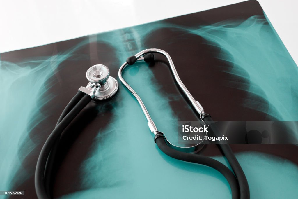 X-ray lung with stehoscope close up X-ray lung with stehoscope background Alternative Therapy Stock Photo