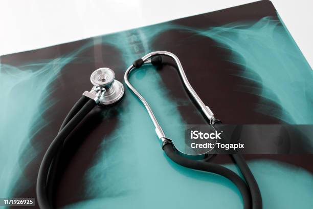 Xray Lung With Stehoscope Close Up Stock Photo - Download Image Now - Alternative Therapy, Orthopedist, Accessibility