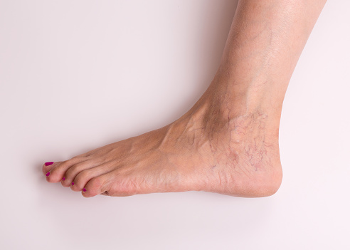 Varicose veins closeup. Leg of a girl with varicose veins on a light background.