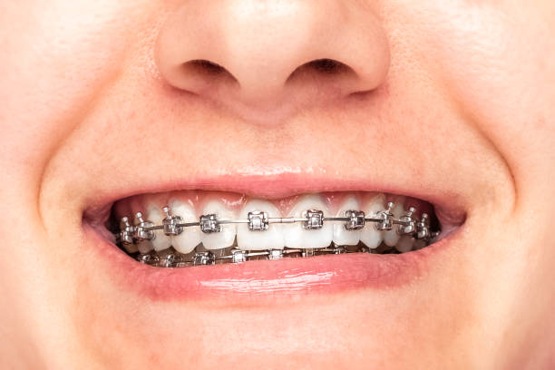 istock Beautiful young woman with braces, closeup 1172013779
