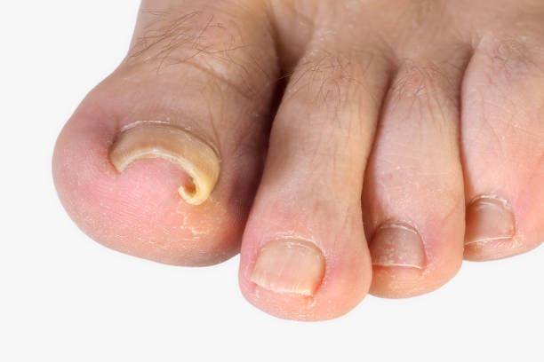 ingrowing toenail (en plus tonail) - big toe photos et images de collection