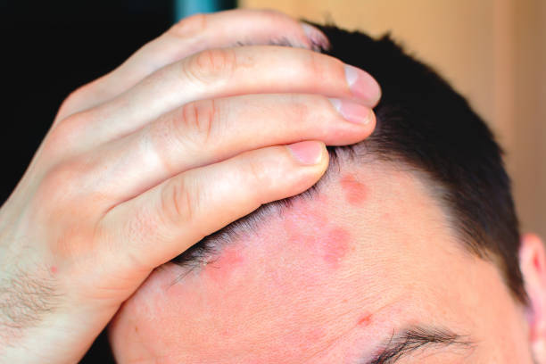 istock Man shows red psoriasis on his forehead 1172147376
