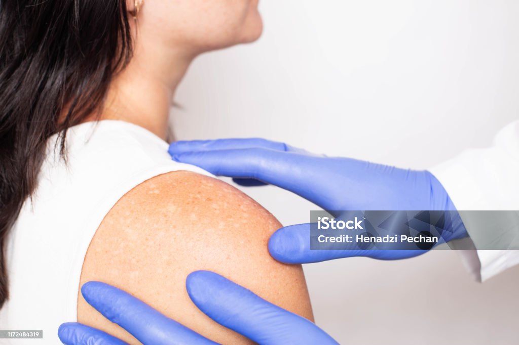 Arzt Dermatologe führt medizinische Untersuchung der Problemhaut auf der Schulter des Patienten, Pigmentflecken auf der Haut, Melanin - Lizenzfrei Dermatologe Stock-Foto