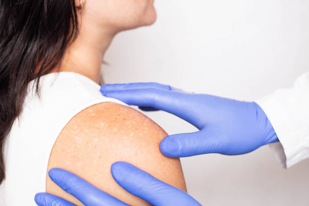 Doctor dermatologist conducts medical examination of problem skin on the patient's shoulder, pigment spots on the skin, melanin Doctor dermatologist conducts medical examination of problem skin on the patient's shoulder, pigment spots on the skin, melanin, healthcare melanin photos stock pictures, royalty-free photos & images