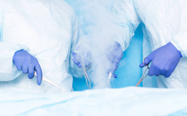 två kirurger av hiurge göra kirurgi med flytande kväve kryoterapi att ta bort maligna tumörer, tumörer. modern metod för behandling kryokirurgi, hemorrojder - basalcellscancer bildbanksfoton och bilder