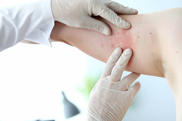 Male doctor in white protective gloves examing patient Male doctor in white latex gloves examines patient with skin disease against office background. Allergy treatment concept fungus stock pictures, royalty-free photos & images
