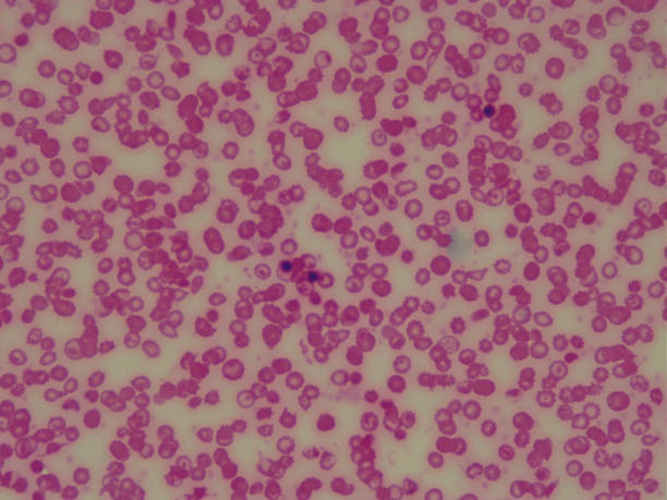 Sickle cell anemia red blood cells under microscope Red blood cells of a patient with sickle cell anemia under the microscope. sickle cell stock pictures, royalty-free photos & images