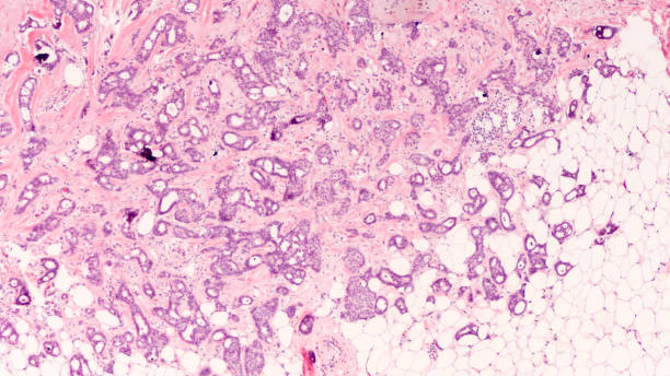 Breast Cancer Microscopic Breast Cancer Awareness: Microscopic image (photomicrograph) of an excision (lumpectomy) for infiltrating (invasive) cribriform  carcinoma, detected by screening mammogram. H & E stain. adenocarcinoma photos stock pictures, royalty-free photos & images