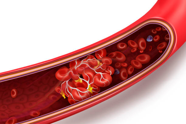 skrzep krwi (skrzepliny) w cieczy. ilustracja wektorowa 3d izolowana na białym przezroczystym tle - human cardiovascular system blood human blood vessel platelet stock illustrations