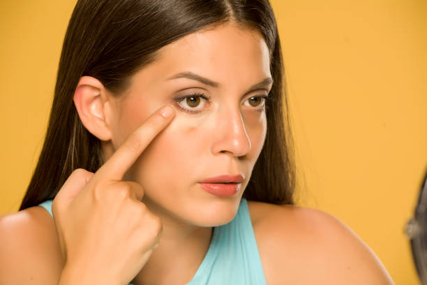 istock Young woman applying concealer on her low eyelids on yellow background 1172681886