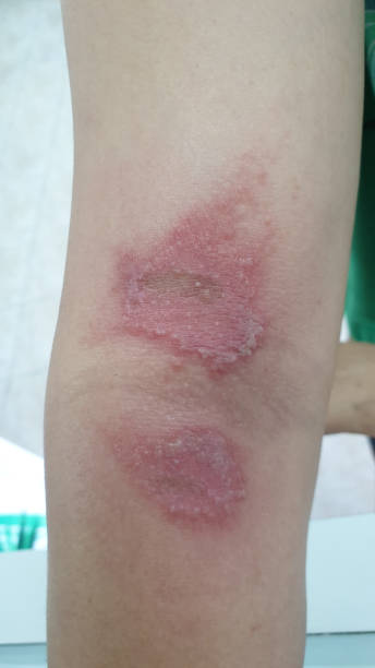 istock virus herpes contagious diseases on arm 1172723571