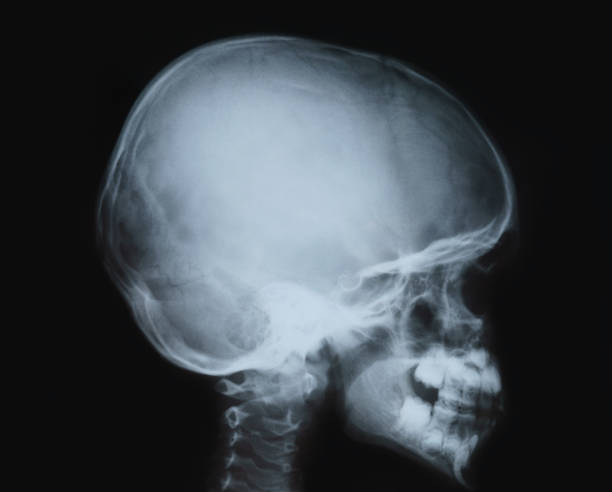 X-ray film of the head, child's skull. stock photo