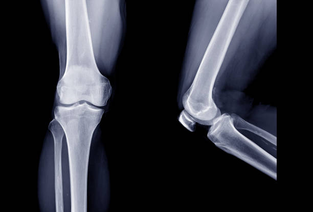 x-ray image of right knee joint  ap view and lateral view. knee x-ray. - osteoarthritis doctor medicine healthcare and medicine imagens e fotografias de stock