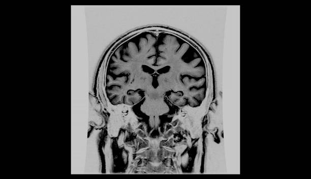 brain mri scan zdrowego mężczyzny (rezonans magnetyczny) wysoka rozdzielczość - mri scan cat scan machine x ray brain zdjęcia i obrazy z banku zdjęć