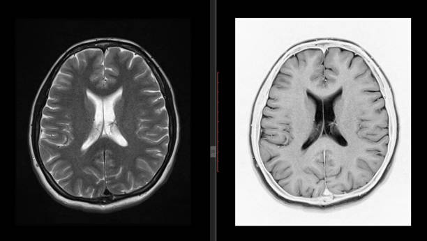 brain mri scan zdrowego mężczyzny (rezonans magnetyczny) wysoka rozdzielczość - human nervous system cat scan brain doctor zdjęcia i obrazy z banku zdjęć