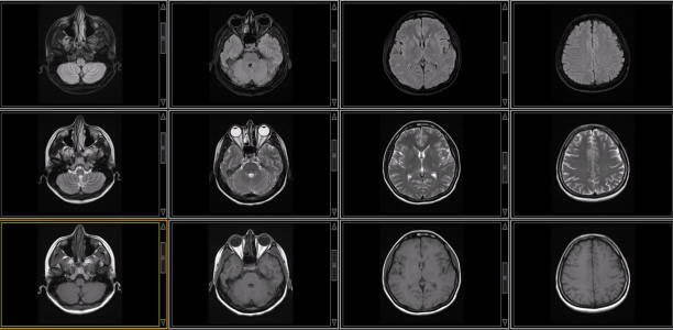 resonancia magnética cerebral de hombre sano (imágenes de resonancia magnética) de alta resolución - mri scan human nervous system brain medical scan fotografías e imágenes de stock