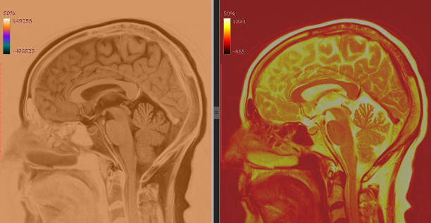 brain mri scan zdrowego mężczyzny (rezonans magnetyczny) wysoka rozdzielczość - human nervous system cat scan brain doctor zdjęcia i obrazy z banku zdjęć