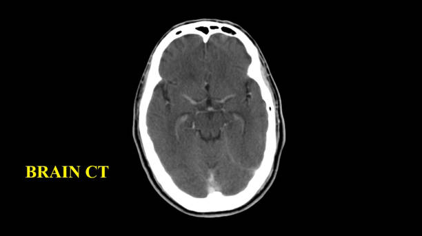 tomografia komputerowa mózgu (tomografia komputerowa głowy) wysoka rozdzielczość - human nervous system cat scan brain doctor zdjęcia i obrazy z banku zdjęć