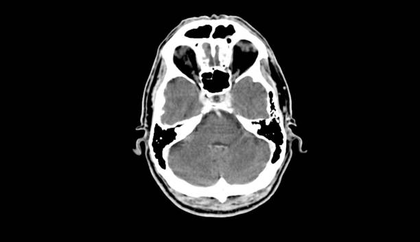 cérebro ct scan (tomografia computadorizada de cabeça) de alta resolução - neuroscience mri scan brain brain surgery - fotografias e filmes do acervo