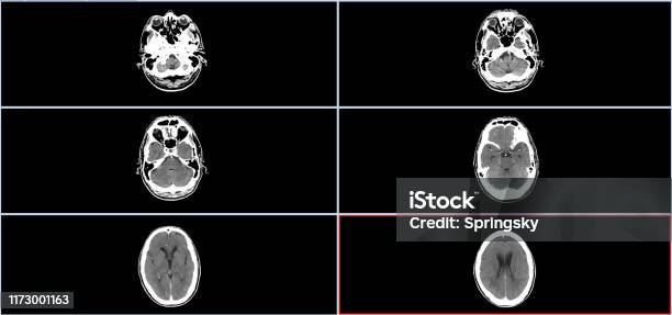 Ct Scan Brainline Brain Ct Scan High Resolution Stock Photo - Download Image Now - iStock