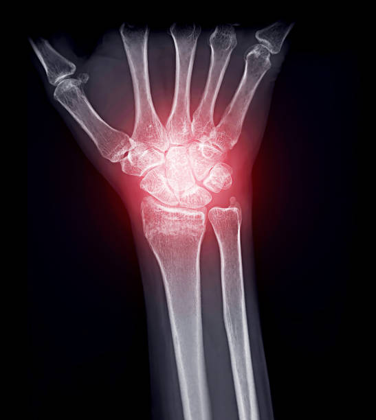 istock X-ray image of wrist joint . 1173031504