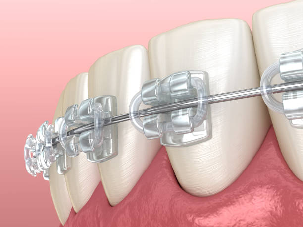 istock Mandibular jaw and Clear braces. Medically accurate dental 3D illustration 1173098721