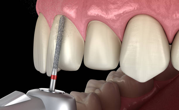 central incisor vorbereitungsprozess für die zahnärztliche veneer platzierung. medizinisch genaue 3d-illustration - handpiece stock-fotos und bilder