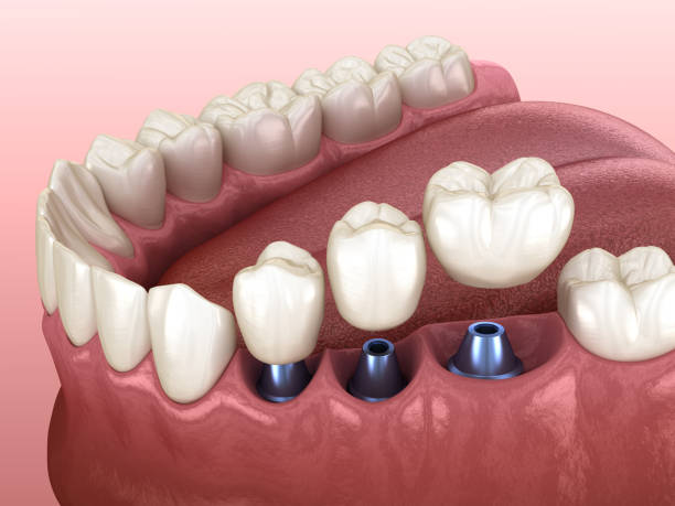 istock 3 tooth crowns placement over 3 implants - concept. 3D illustration of human teeth and dentures 1173099562