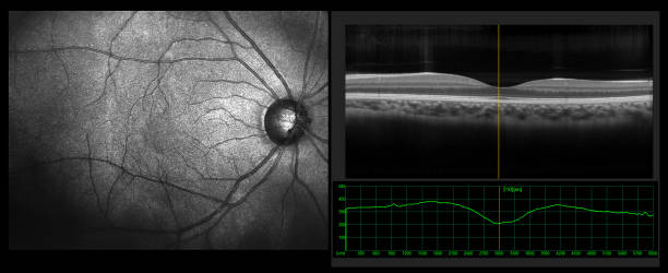 Ophthalmic test - OCT optical coherence tomography measurement. SLO Scan view of the macula in retina with vessels Ophthalmic test - OCT optical coherence tomography measurement. SLO Scan view of the macula in retina with vessels tomography photos stock pictures, royalty-free photos & images