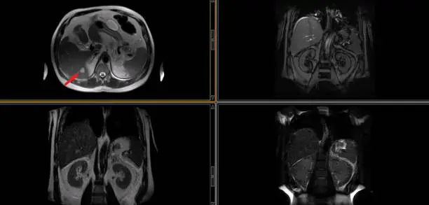 Photo of CT SCAN of Thorax and Abdomen (Computed Tomography- CAT)