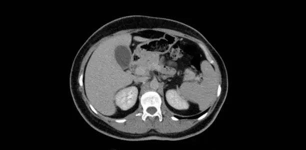 Photo of CT SCAN of Thorax and Abdomen (Computed Tomography- CAT)