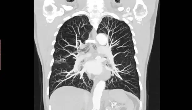 Photo of CT SCAN of Thorax and Abdomen (Computed Tomography- CAT)