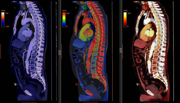 흉부와 복부의 ct 스캔 (컴퓨터 단층 촬영 - cat) - human spine mri scan x ray doctor 뉴스 사진 이미지
