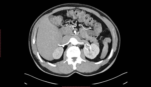 istock CT SCAN of Thorax and Abdomen (Computed Tomography- CAT) 1173165072