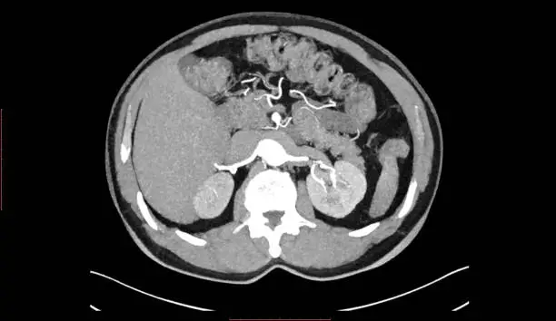 Photo of CT SCAN of Thorax and Abdomen (Computed Tomography- CAT)