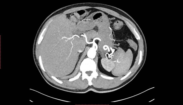 istock CT SCAN of Thorax and Abdomen (Computed Tomography- CAT) 1173165174