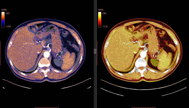 istock CT SCAN of Thorax and Abdomen (Computed Tomography- CAT) 1173165257