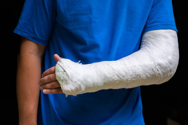 Man with broken arm wrapped medical cast plaster. Fiberglass cast covering the wrist, arm, elbow after sport accident, isolated on black Man with broken arm wrapped medical cast plaster. Fiberglass cast covering the wrist, arm, elbow after sport accident, isolated on black eurasian griffon vulture photos stock pictures, royalty-free photos & images