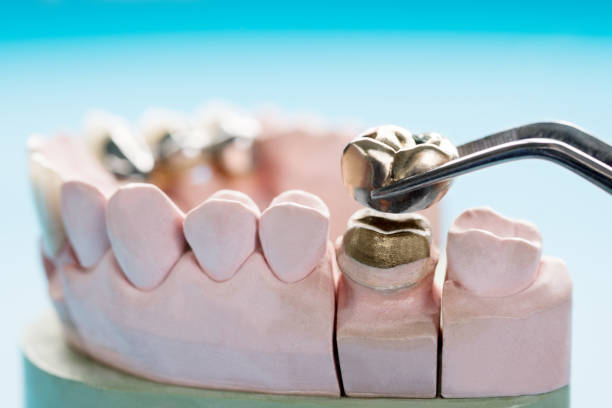 istock Close up implant and prosthodontic model. 1173270578