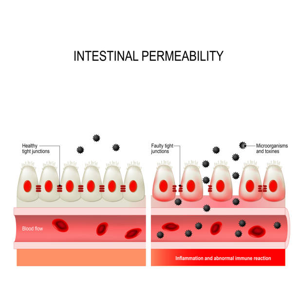 leaky gut. Intestinal permeability leaky gut. Intestinal permeability. cells on gut lining held tightly together. in intestine with celiac disease and gluten sensitivity these tight junctions are open. substances, microbes and toxines uncontrolled passage into the bloodstream. development of immune and inflammatory reactions. autoimmune disorder. blood and guts stock illustrations