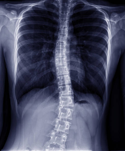 röntgenaufnahme der thorax-lumbar-spinne im dunklen hintergrund. thoraco-lumbar skoliose. - human vertebra fotos stock-fotos und bilder