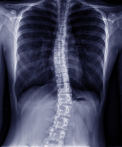 暗い背景の胸部-腰椎のx線。胸部-腰椎症。 - scoliosis ストックフォトと画像