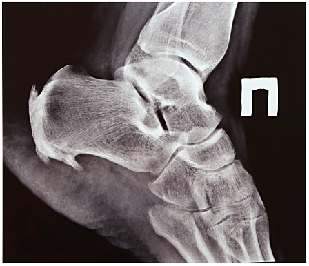 An X-ray of the right heel shows a calcaneal spur in the lower part of the heel and osteophyte of the calcaneus (or Haglund's disease) in the back of the heel