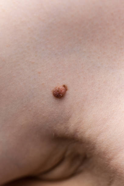 istock Unrecognizable person having dark fibroma 1173559387