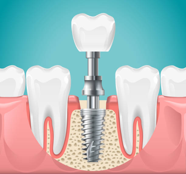 illustrations, cliparts, dessins animés et icônes de cabinet. illustration de vecteur de coupe de coupe d'implant de de dent. dents saines et implant dentaire, affiche de stomatologie - artificial metal healthcare and medicine technology