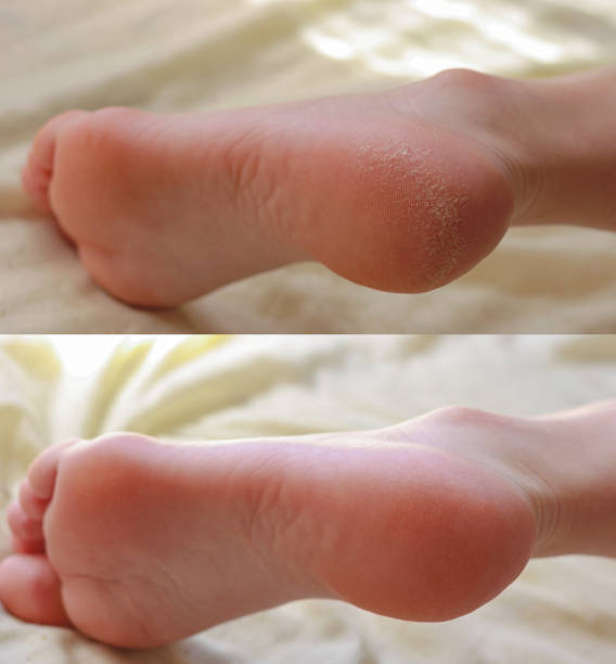 Pedicure. Cracks and dry callus on the heels. Sloppy and groomed legs. Lack of vitamins. Skin diseases feet. Before and after treatment. stock photo