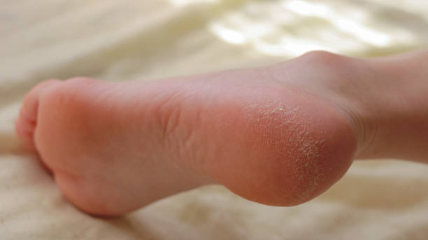 Pedicure. Cracks and dry callus on the heels. Sloppy and groomed legs. Lack of vitamins. Skin diseases feet stock photo